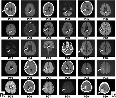 Higher prefrontal activity based on short-term neurofeedback training can prevent working memory decline in acute stroke